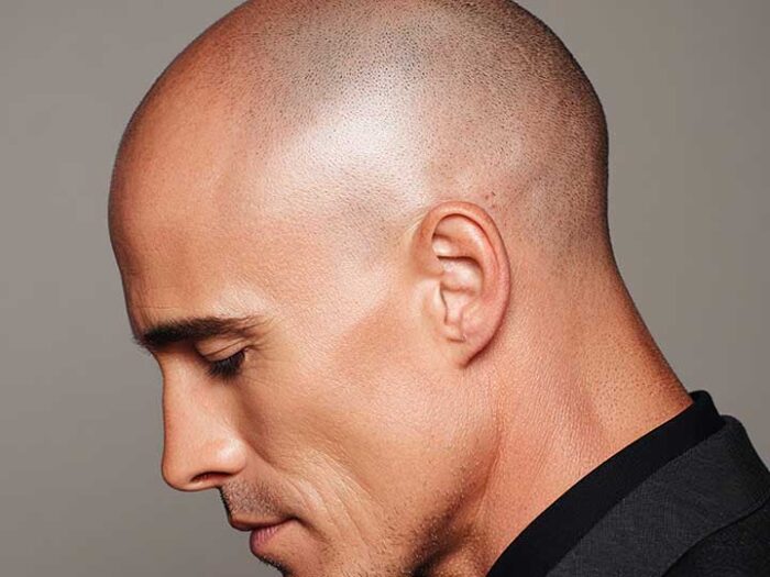 Telogenowe wypadanie włosów – objawy, przyczyny, diagnostyka i leczenie